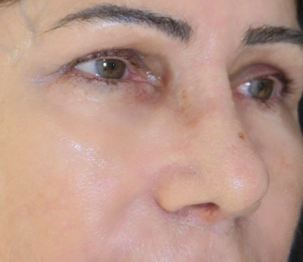 Rinoplastia Pele Com Vida - Imagem de Capa